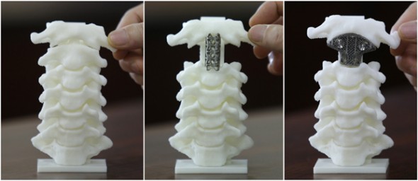 Combination picture of a spine model, a spine model implanted with a traditionally used titanium tube and a spine model implanted with a 3D printed artificial axis, are seen at Peking University Third Hospital in Beijing