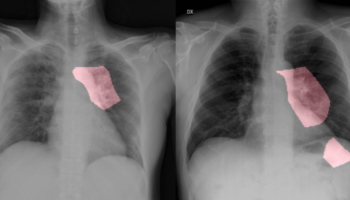 chest-x-ray-resized